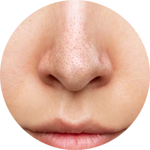 Blackheads