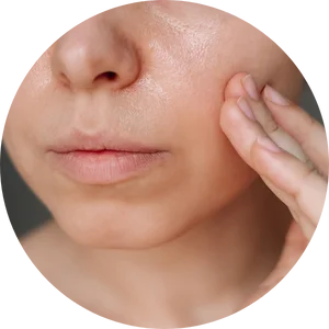 Oily Skin