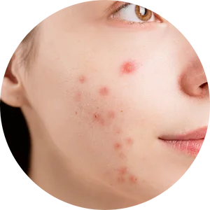 Acne