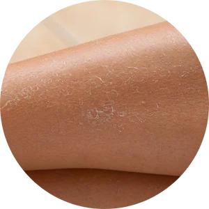 Dry Skin